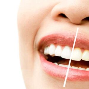 Blanqueamiento Dental
