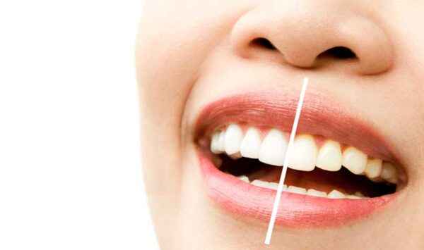 Blanqueamiento Dental
