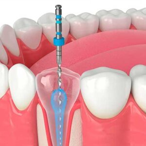 Endodoncia