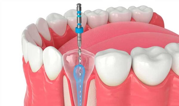 Endodoncia
