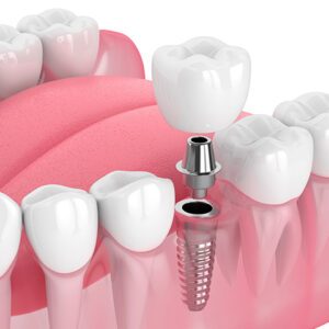 Implante Dental